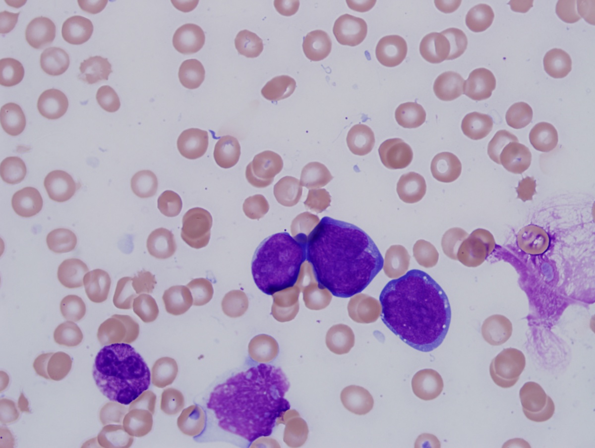 BM biopsy 2 peripheral blood vacuoles 100x